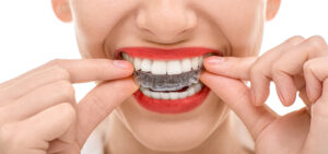 Straight talk about Invisalign for Adults