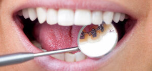 lingual braces