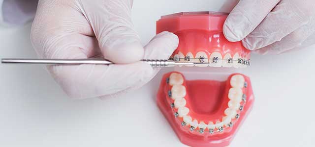 BracesImage