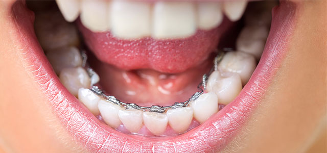 invisalign vs lingual braces